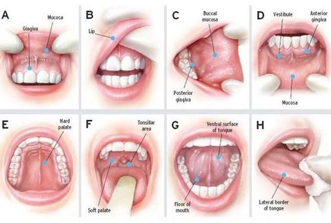 Nhiệt miệng - Hình ảnh minh họa
